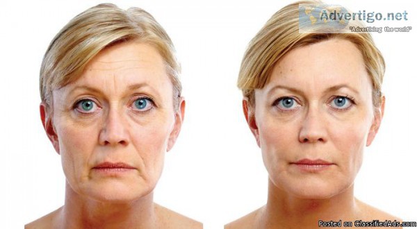 399 per syringe - Restylane or Juvederm Facial Filler