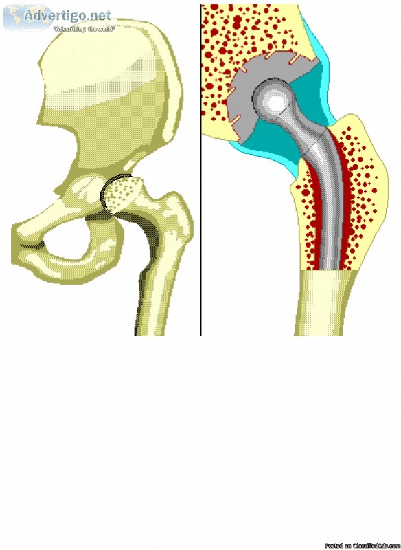 BEST HIP REPLACEMENT SURGERY IN INDIA