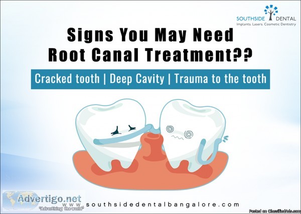 Root Canal treatment In Basavangudi Bangalore