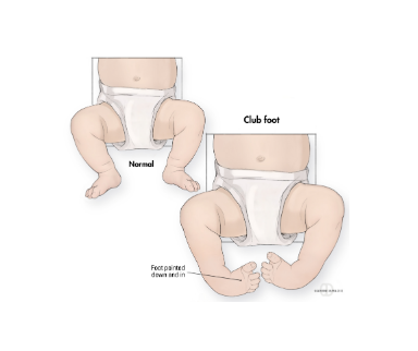 What causes clubfoot in a fetus