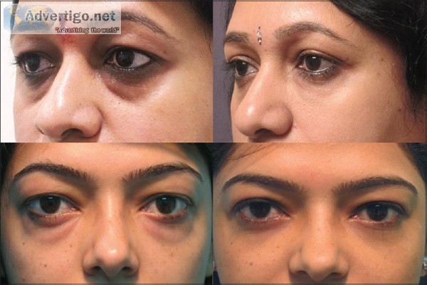 Fine Lines and Wrinkles Treatment In Chennai