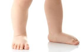 Flatfeet Prevention &ndash Flatfeet - Kids Orthopedic