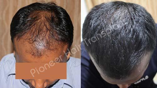 Best Hair Transplant Bangalore