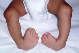 How is clubfoot treated