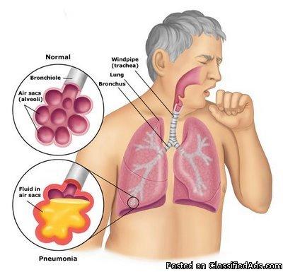 6 Best Homeopathic Medicines for ASTHMA Treatment