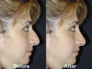 Top Rhinoplasty Surgeon in Los Angeles  Calwestent.com