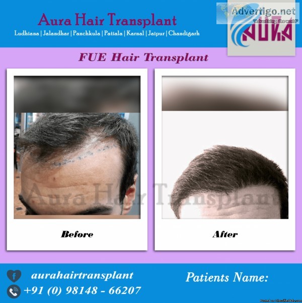 Punjab FUE Hair Transplant