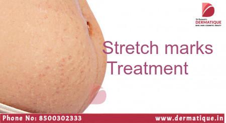 Stretch Marks Treatment In Banjarahills