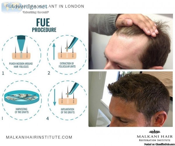 Malkani Hair Restoration Institute