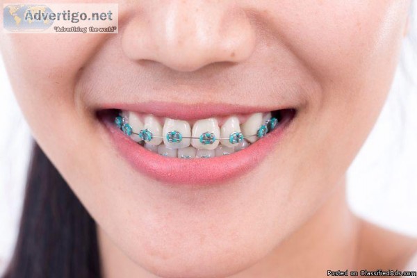 Braces Treatment in UK