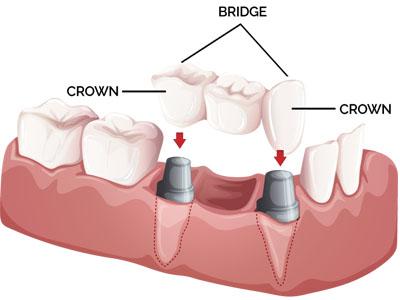 Choose one of the best dental implant in Kalighat from others