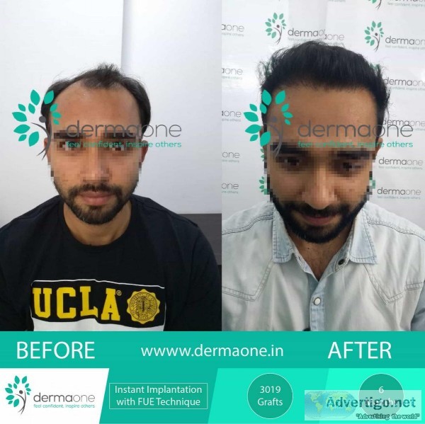 Hair Transplant in Delhi