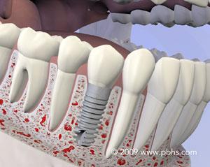 Replace Missing Tooth  Sunset Periodontics