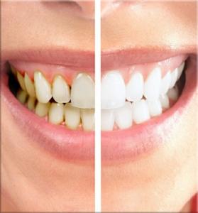 Ceramic or Porcelain Veneers Treatment