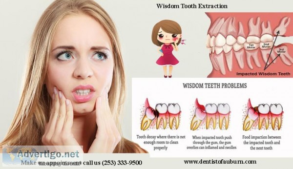 Wisdom Tooth Extraction Auburn  Best dentist in auburn WA