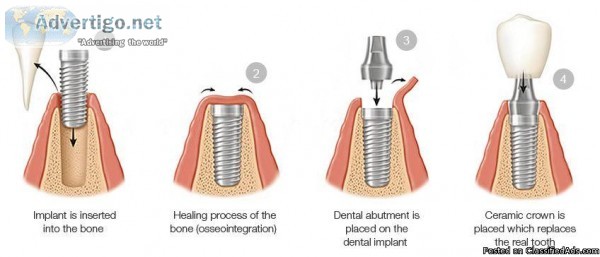 Dental Implants Treatment in Australia