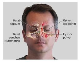 Best Sinus Doctor and Surgeon in Los Angeles  Calwestent.com