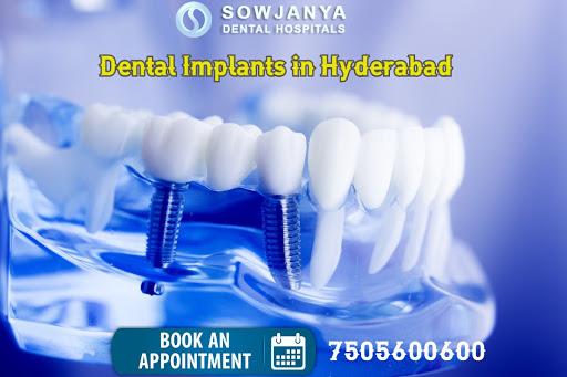 Dental Implants in Hyderabad  Best Dental Doctors in Himayat Nag