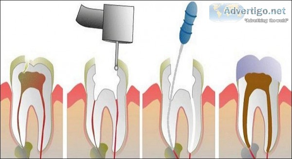 Root Canal Treatment in Delhi By Expert Dentist