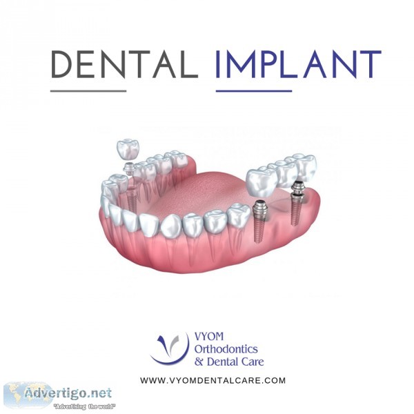 Dental implants in Ahmedabad  Best Dental Implants in Ahmedabad