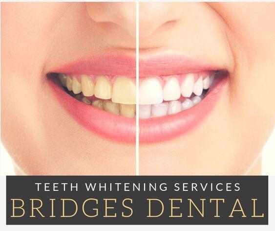 Brandon Dentist &ndash Crowns Teeth Whitening Fillings Dentures