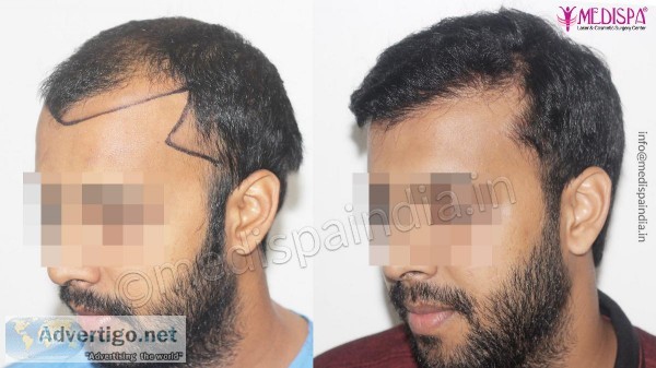 Get the best Hair Transplant in Bhubaneswar at Medispa