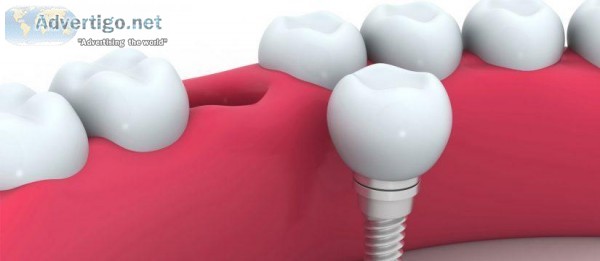 Holistic Dental Brunswick - Affordable Dental Implants Melbourne