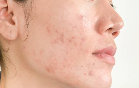 Best dermatologist in Gurgaon for Acne Treatment