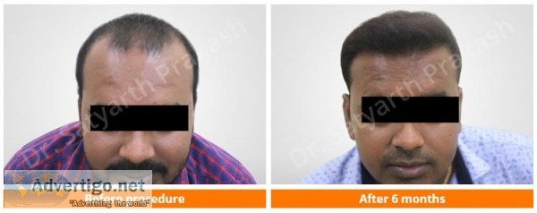 Hair Transplant Clinic In Bhubaneswar