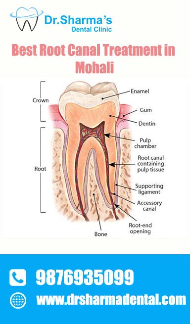 Best Root Canal Treatment In Mohali