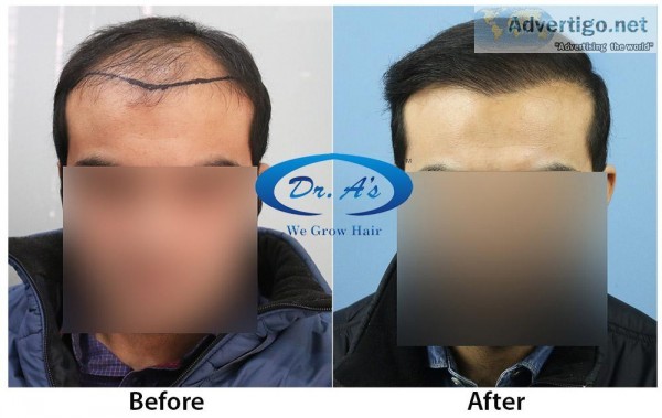 Hair Loss Treatment in Delhi