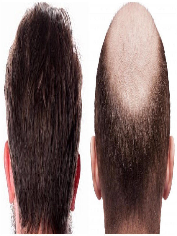 Hair transplant cost in kerala