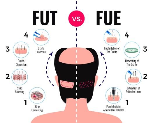 FUE vs FUT Hair Transplant