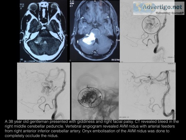 Complete cure of a ruptured cerebellar avm by endovascular embol