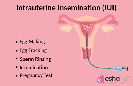 Best iui centre in hyderabad