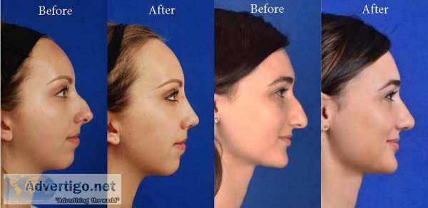 Get the most affordable rhinoplasty cost in lahore