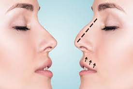 Get the most affordable rhinoplasty cost in lahore