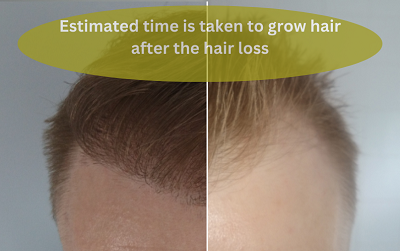 The time it takes to restore hair after hair loss is estimated.