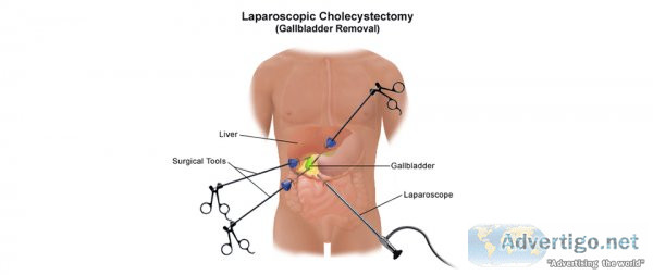 Navigating gallbladder removal in lahore: cost, procedure, and c