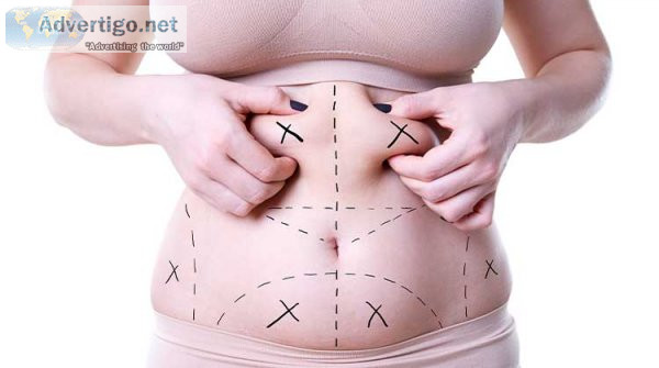 Tummy tuck in dubai