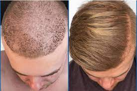 Hair transplants in dubai