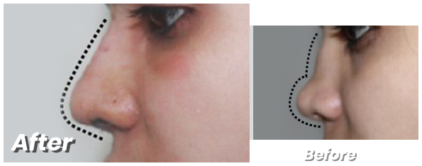 Best rhinoplasty surgeon in lahore