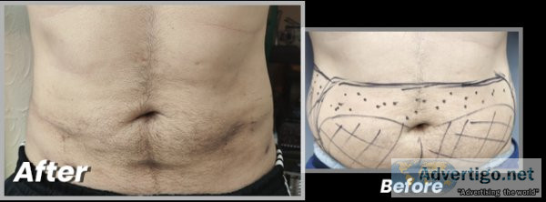 Liposuction in pakistan cost