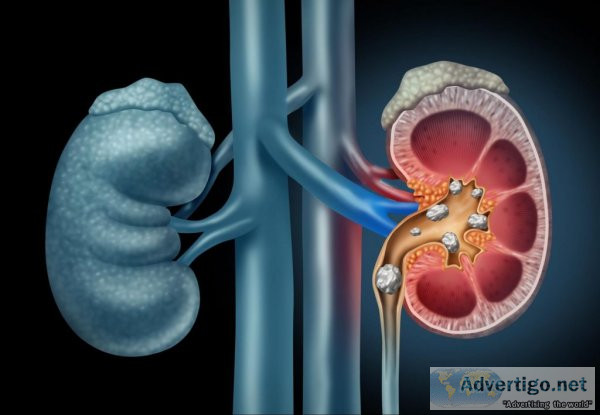 Best urology hospital in lucknow - apollomedics Hospital