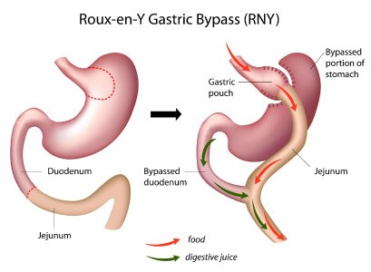 Bariatric surgery cost in pakistan