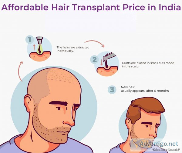 Affordable hair transplant price in india