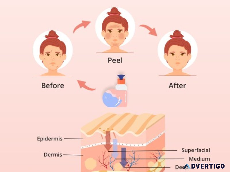 Chemical peel treatment in hyderabad