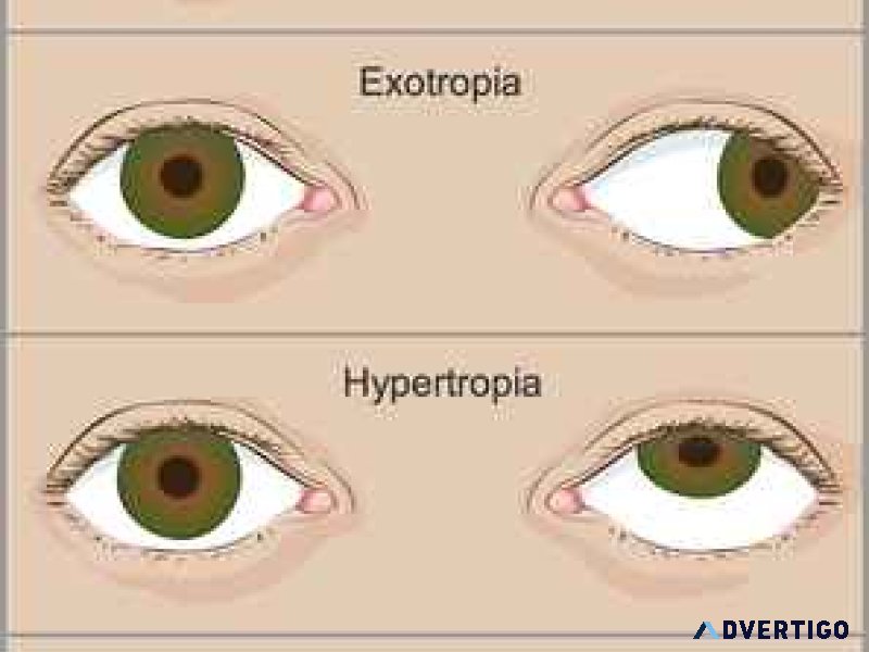 Top hospital for squint in eyes treatment in delhi