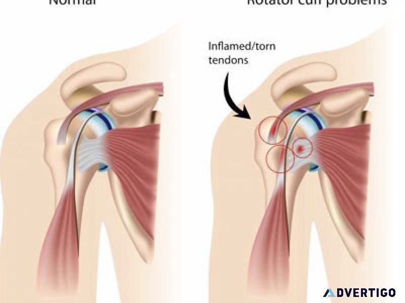 Rotator cuff tear treatment in delhi