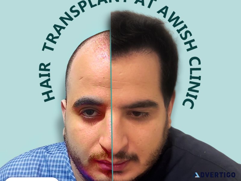 Hair transplant clinic in delhi ncr